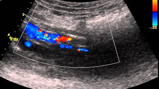 ILIAC ARTERY STENOSIS [upl. by Rubliw]