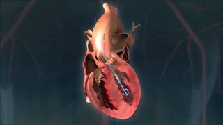 Impella  Eternal Hospital  Worlds Smallest Heart Pump [upl. by Amikan]