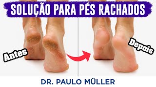 Solução para Pés Rachados e Ressecados – Dr Paulo Müller Dermatologista [upl. by Lepp]