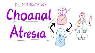 Choanal Atresia  Pink on crying blue on breastfeeding 🤱 ENT amp Pulmonology [upl. by Eahc]