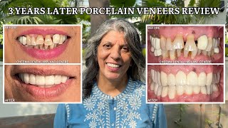 Full Mouth Porcelain Veneers after 3 years review  UK Patient [upl. by Nnylodnewg]