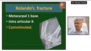 Rolandos fracture Fracture metacarpal  Dr Pankaj Jindal  HAND SURGERY [upl. by Hali]