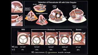 Echocardiographic Assessment of Prosthetic Valves [upl. by Nnylatsyrc758]