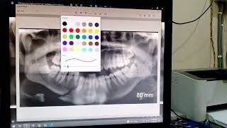 How to easily about for opg xray fracture [upl. by Papagena694]