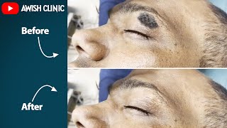 SEBORRHEIC KERATOSIS TREATMENT  Skin Horn सींग removal  By Dr Vijay Kumar [upl. by Aserahs]