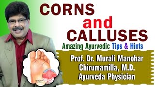 Corns and Calluses  Ayurvedic Remedies  Prof Dr Murali Manohar Chirumamilla MD Ayurveda [upl. by Alocin]