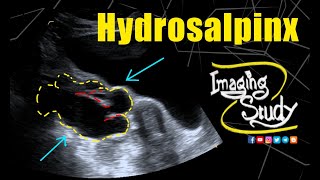 Hydrosalpinx  Ultrasound  Case 329 [upl. by Lehctim]