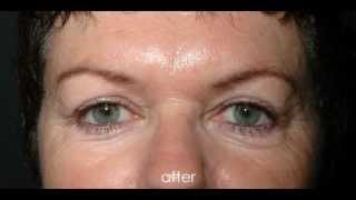 Upper Eyelid Correction [upl. by Cis]