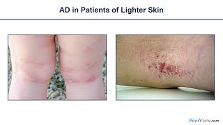 Pediatric Atopic Dermatitis Assessing Disease Severity and Implementing Targeted Treatment [upl. by Whyte]