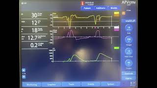 A Case of Patientventilator Asynchrony [upl. by Nnairac]