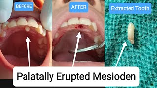 🇳🇵Extraction of Supernumerary Tooth Mesiodens Extra Tooth Exodontia Palatally Erupted nepal [upl. by Price]