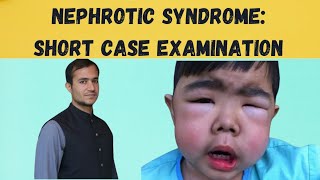 NEPHROTIC SYNDROME Practical approach to short case examination [upl. by Suoinuj]