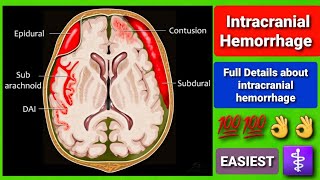 Intracranial haemorrhage Typessignsymptoms full detail [upl. by Fogel]