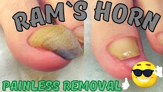 How to remove Rams Horn toenail without pain Medical pedicure [upl. by Pricilla]