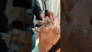 Cupping therapy bestphysiotherapy physiotherapyandrehabilitation [upl. by Busey]