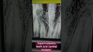 supernumerary teeth bw central incisors dentalcafe4331 [upl. by Wolff]