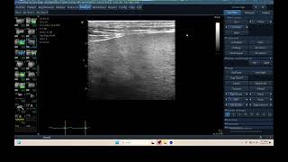 IQ 305 LIVER ULTRASOUND ECHOPAC ANALYSIS HEPATOMA [upl. by Bumgardner]