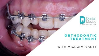 Orthodontic treatment with microimplants [upl. by Aikan910]