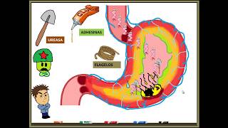 HELICOBACTER PYLORI GASTRITIS [upl. by Parfitt]