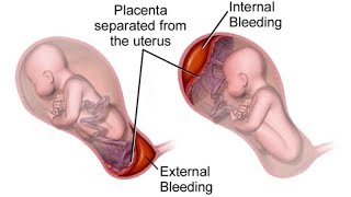 What is antepartum haemorrhage😷How to manage APHdrsaminakhurshidgynaecolog4661 [upl. by Cousin92]