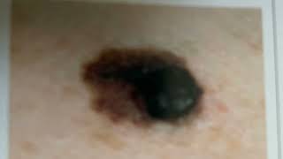 Learn 2 Signs of Skin Cancer amp How They Look on the Skin [upl. by Klockau636]