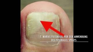 Fußnägel pflegen Fußpflege mit dem Fußnagel Spray selber machen [upl. by Oiril]