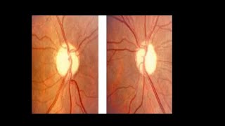 Optic atrophy Primary Secondary glaucomatous optic atrophy AnterogradeRetrograde AION RNFL [upl. by Loeb792]