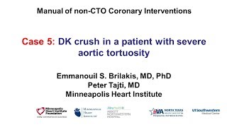 Case 5 PCI Manual  Aortic Tortuosity and DK crush [upl. by Annauqahs656]