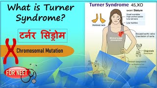 What is Turner Syndrome  Turner’s Syndrome  Principles of Inheritance and Variation  NEET [upl. by Wil]