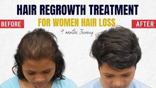 PRP Hair Loss Treatment For Females Before amp After Results at CARA [upl. by Htidirem]