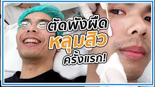 มันคือที่สุด ตัดพังผืด quotหลุมสิวquot Subcision  Picoway Laser ครั้งที่4  NUTTHEP [upl. by Nelluc940]