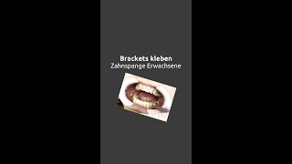 Zahnspange Erwachsene  Brackets kleben shorts [upl. by Ynnavoig]