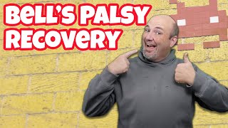 Recovery and Side Effects of Bells Palsy  1 Year Later [upl. by Elimay429]