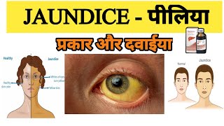 Jaundice treatment  Types of Jaundice  Symptoms of Jaundice  What is main cause of jaundice [upl. by Cheyne]