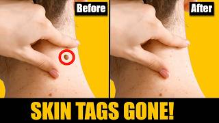 SKIN TAGS Dont Make This Mistake Learn The Best Way To Remove Skin Tags [upl. by Airehtfele]