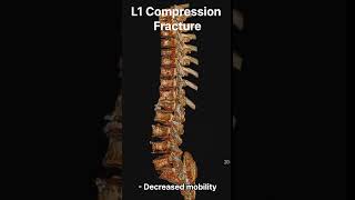 L1 Compression Fracture Understanding Causes Symptoms and Diagnosis 제 1요추 압박골절 원인증상진단에 대한 종합적이해 [upl. by Akimik]