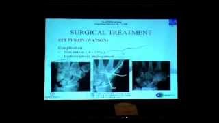 Arthroscopic Scaphoid Trapezium Trapezoid arthritis treatment [upl. by Notnerb644]