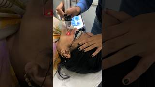 Laser treatment for pigmentation Laser toning  stubborn pigmentation treatment lasertreatments [upl. by Elbys]