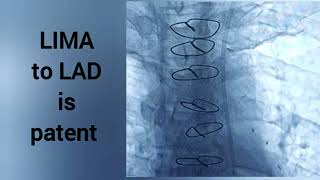 قسطرة تشخيصية وعلاجيه لحاله بعد الجراحة وتركيب دعامات اي الشريان الأيمن PCI after post CABG [upl. by Odlopoel]