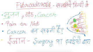 Fibroadenosis of Breast fibroadenosis in Hindi in fibroadenosis ke bare ma ye koi nahi batayega [upl. by Ayaet]