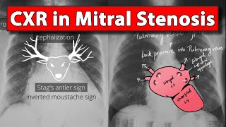 Chest Xray Part 3 in Mitral Stenosis  Made easy [upl. by Cida320]