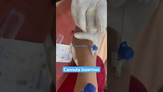 Cannula insertion of female patient nurses cannula shortsmbbs youtubeshorts subscribe neet [upl. by Ysak955]