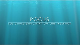 USG GUIDED Subclavian vein CVP Line insertion  infraclavicular approach long axis view  Part 1 [upl. by Velleman]