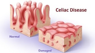 Celiac Disease [upl. by Animrac439]