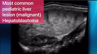 Mesenchymal Hamartoma [upl. by Aryl]