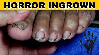 Ingrown Toenail Removal Pedicure [upl. by Yerffoeg38]