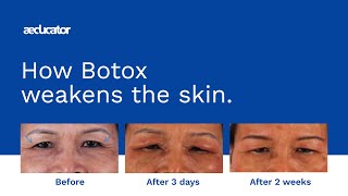 How Botox weakens the skin [upl. by Gus503]