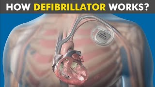 How Defibrillator Works Automated External Defibrillation working mechanism [upl. by Marienthal]