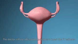 IVF procedure step by step detail explanation [upl. by Norma359]