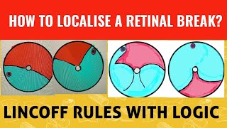 How to localise a retinal break in retinal detachment  lincoff rules [upl. by Summers]